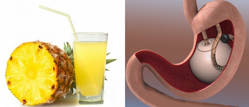 Izquierda: Piña natural y vaso con zumo de piña. Derecha: Imagen de una sección longitudinal del estómago y el balón intragástrico alojado